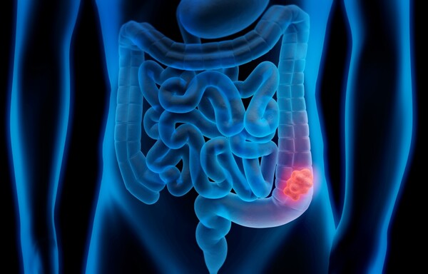 Рак толстой кишки проявляется различными симптомами