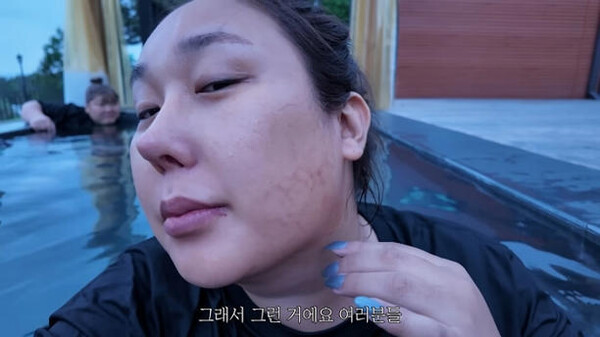 [닥터설레임 피부이야기] 12kg 감량한 풍자, 얼굴 멍의 이유는? “이중턱 없애려다…”